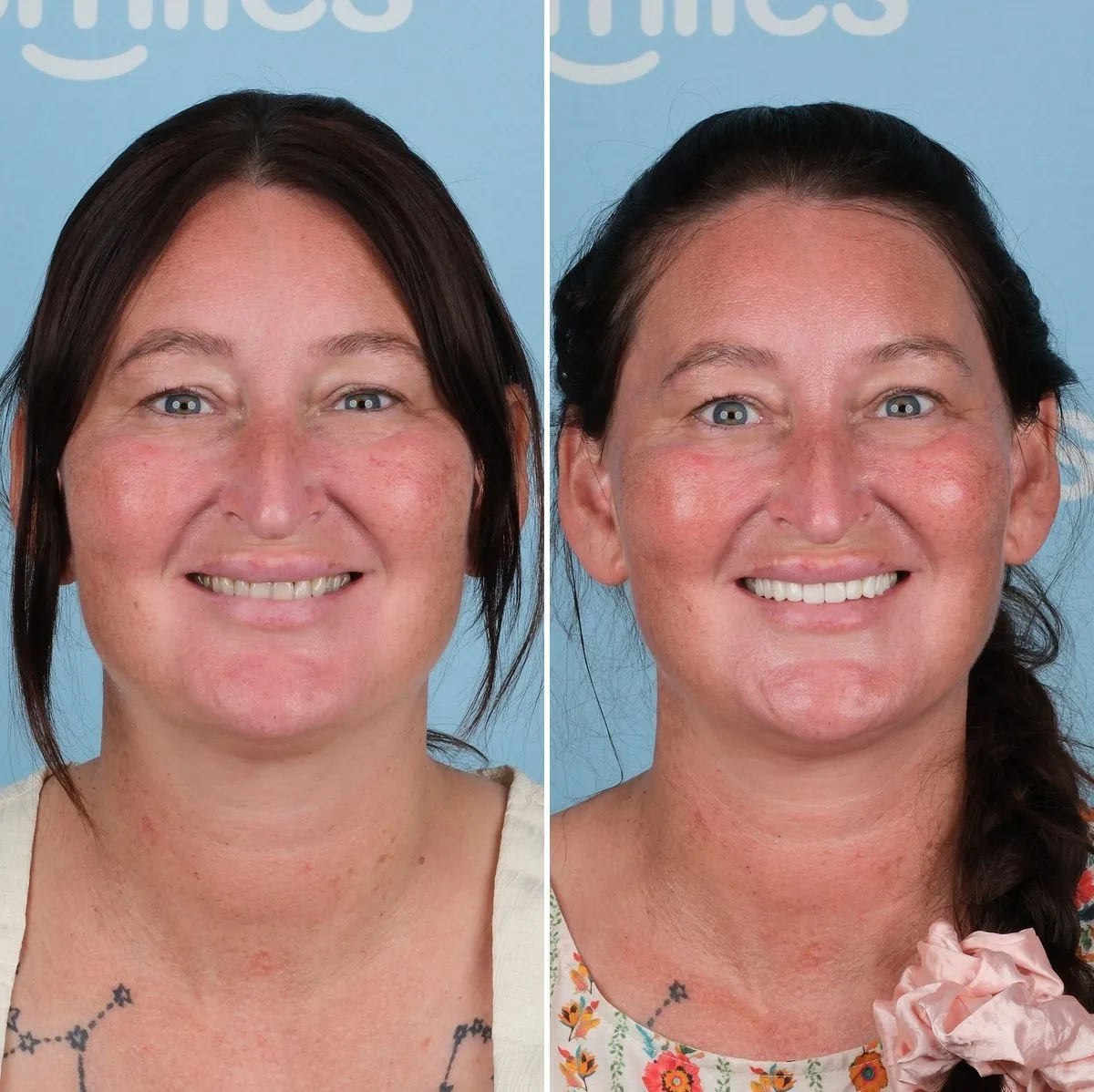 Laura before and after emax crowns with UK Smiles