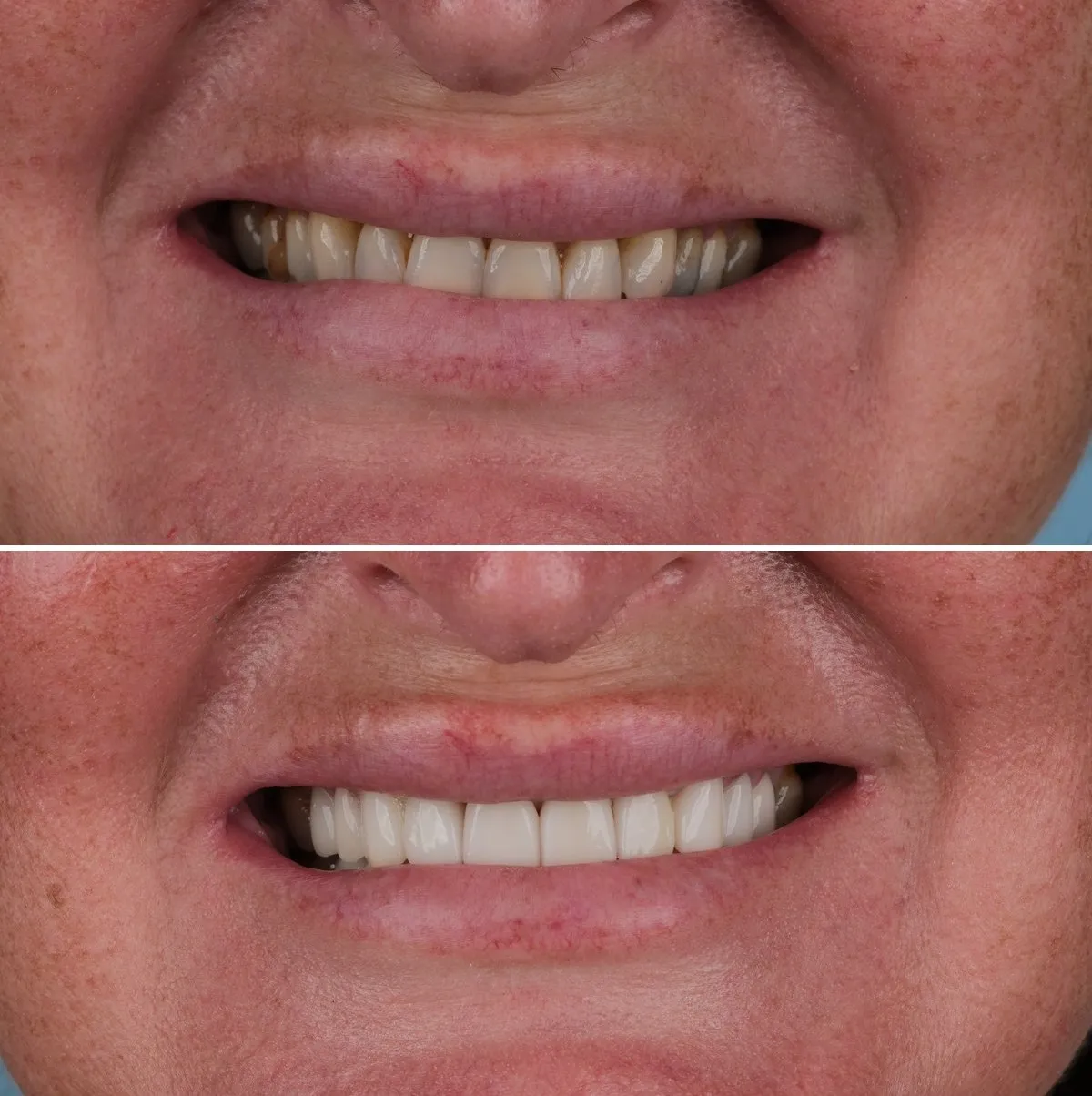 Close-up of Laura's teeth before and after Emax Crowns, view 1