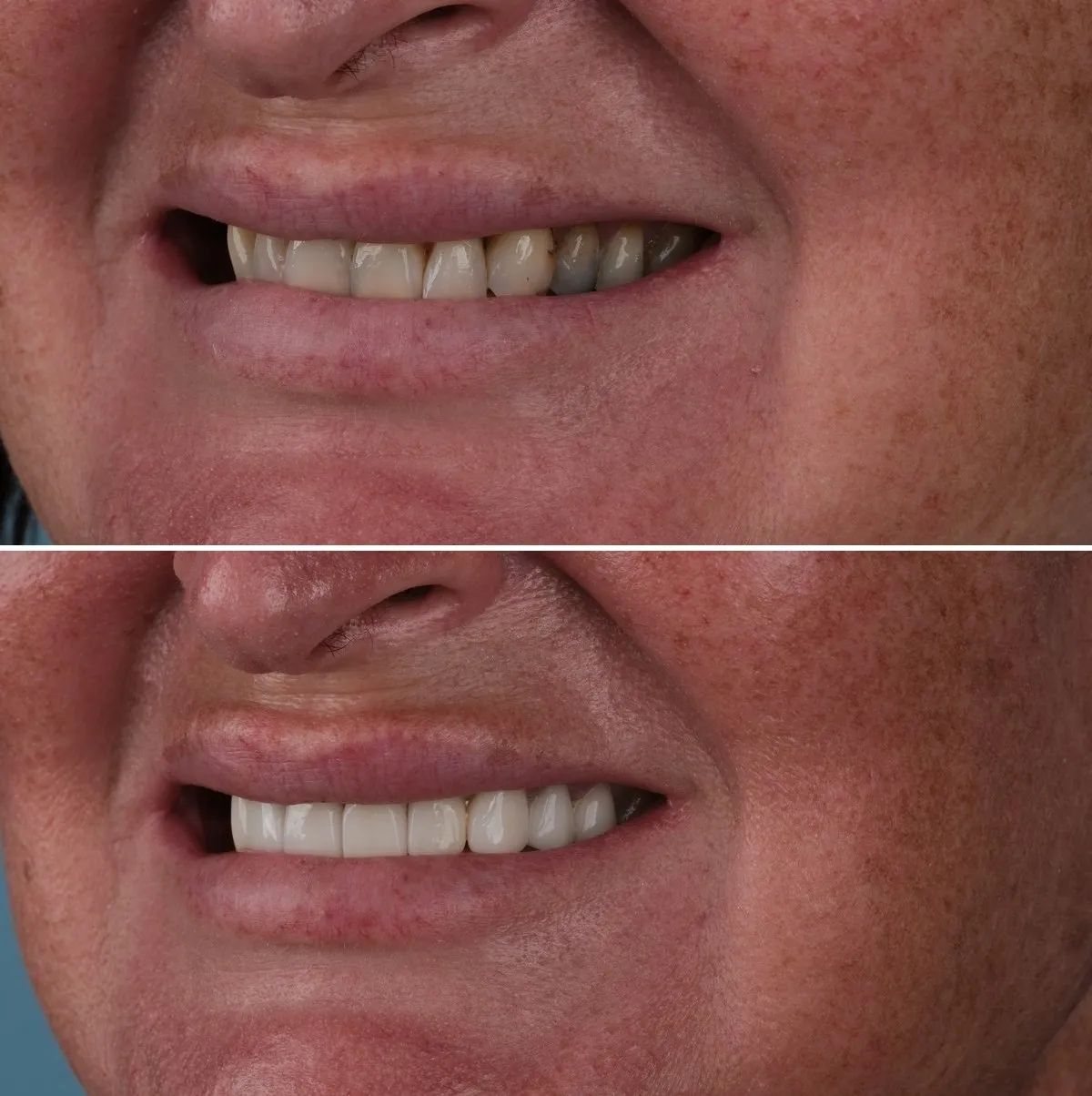 Close-up of Laura's teeth before and after Emax Crowns, view 2