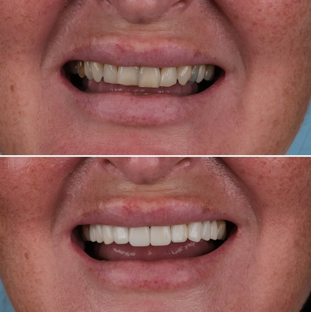 Close-up of Laura's teeth before and after Emax Crowns, view 3