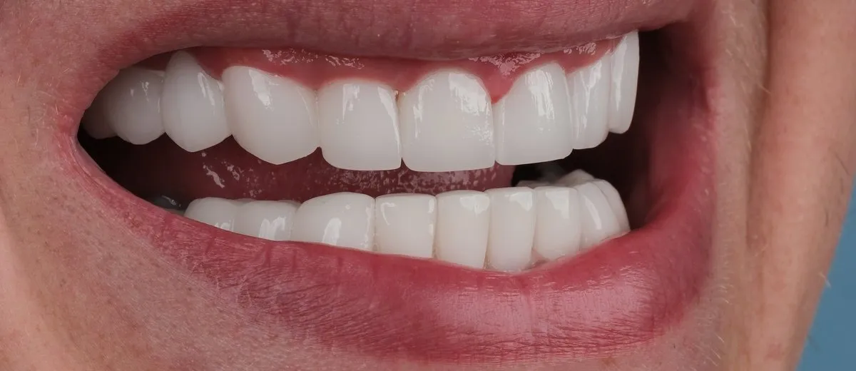A UK Smiles patient's smile after treatment: BL1 shade, Softened style