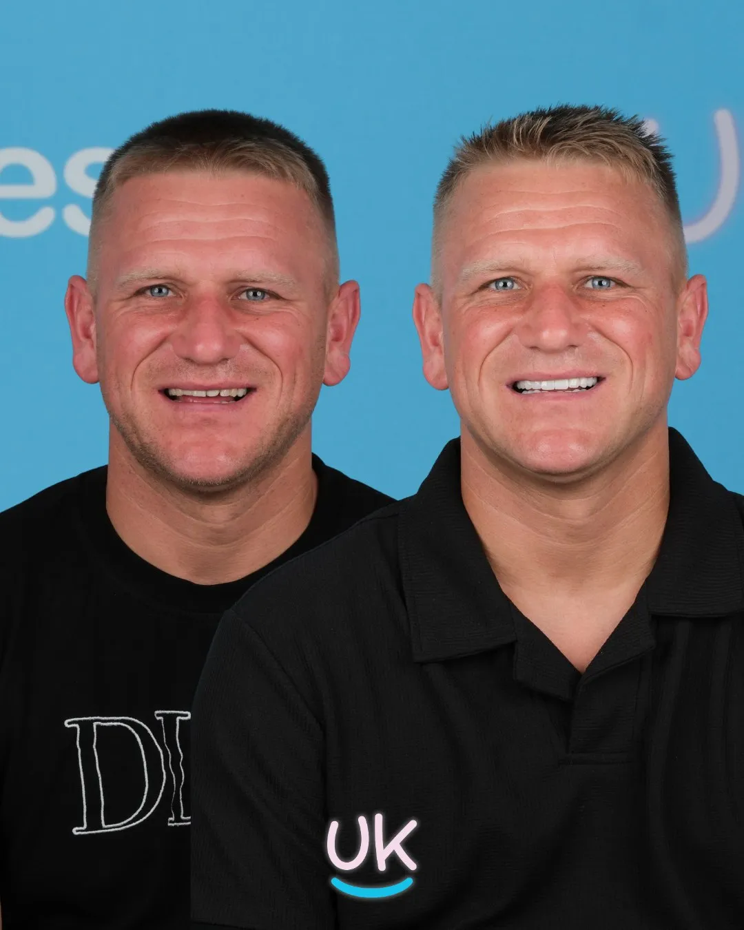 Man in a black polo shirt before and after new teeth in Turkey