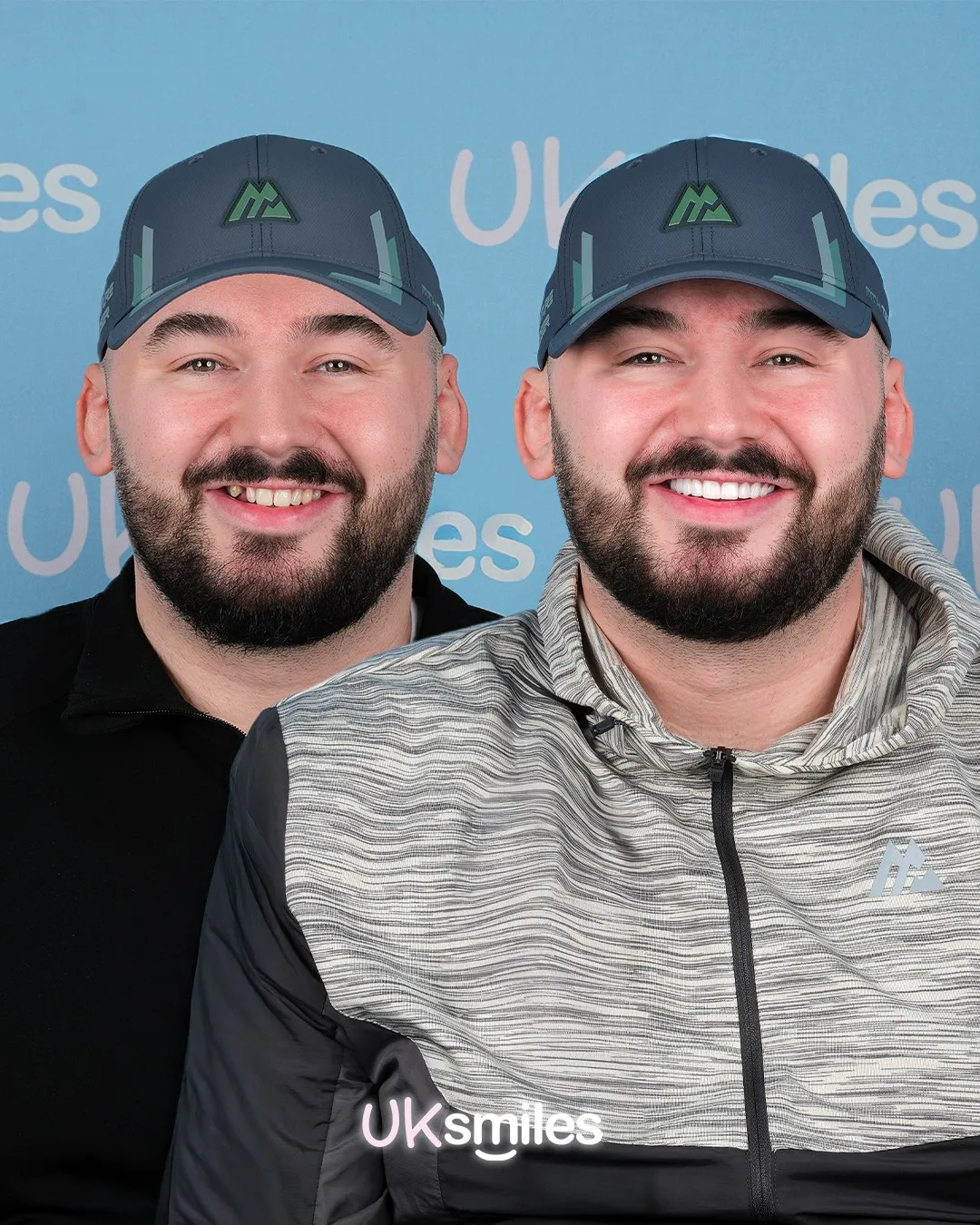 Bearded man in a cap before and after his smile makeover in Antalya