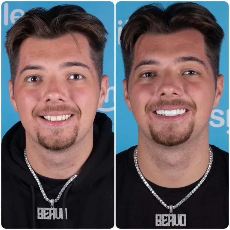 Man with a chain necklace before and after his new teeth