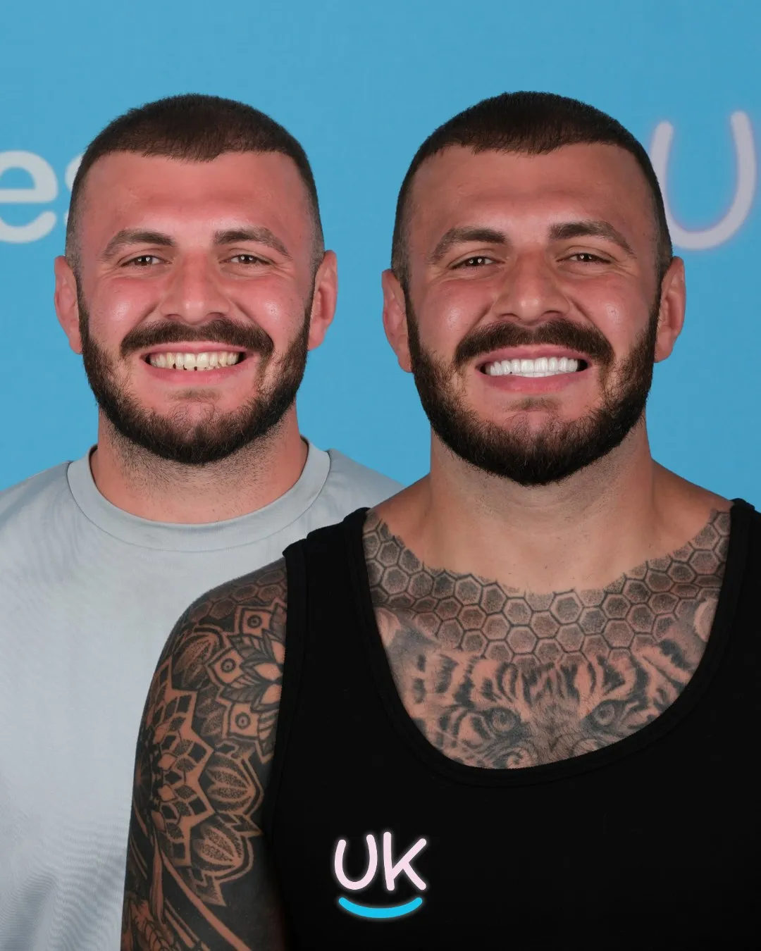 Bearded man with chest tattoos before and after his smile makeover in Turkey