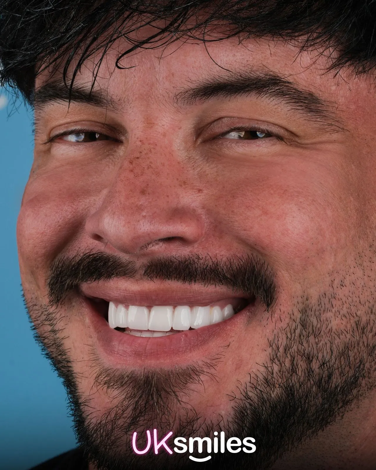 Close-up of a man with a beard showing his new white smile