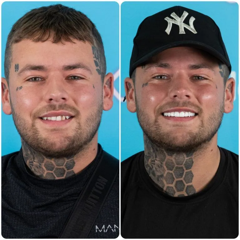 Man with face and neck tattoos before and after his new teeth