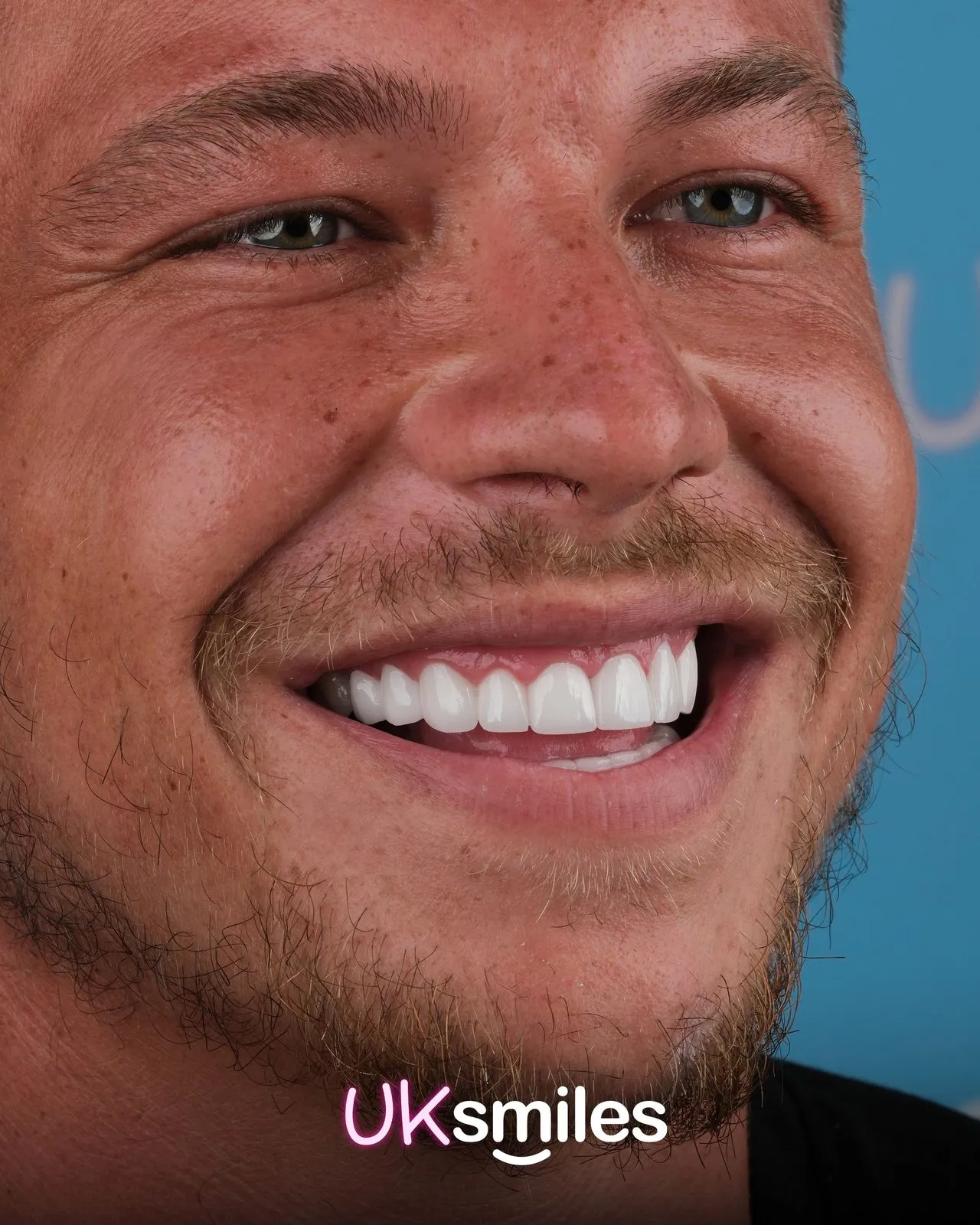 Close-up of a smiling man showing his new teeth