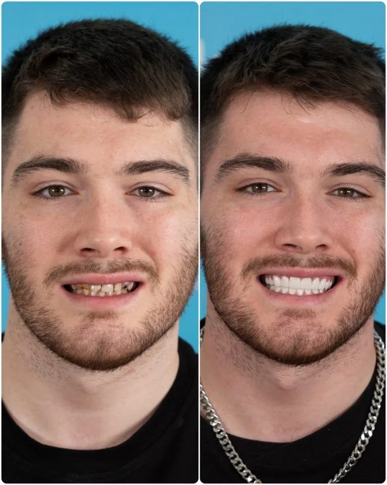 Man with gapped, broken teeth before and a full white smile after treatment in Turkey