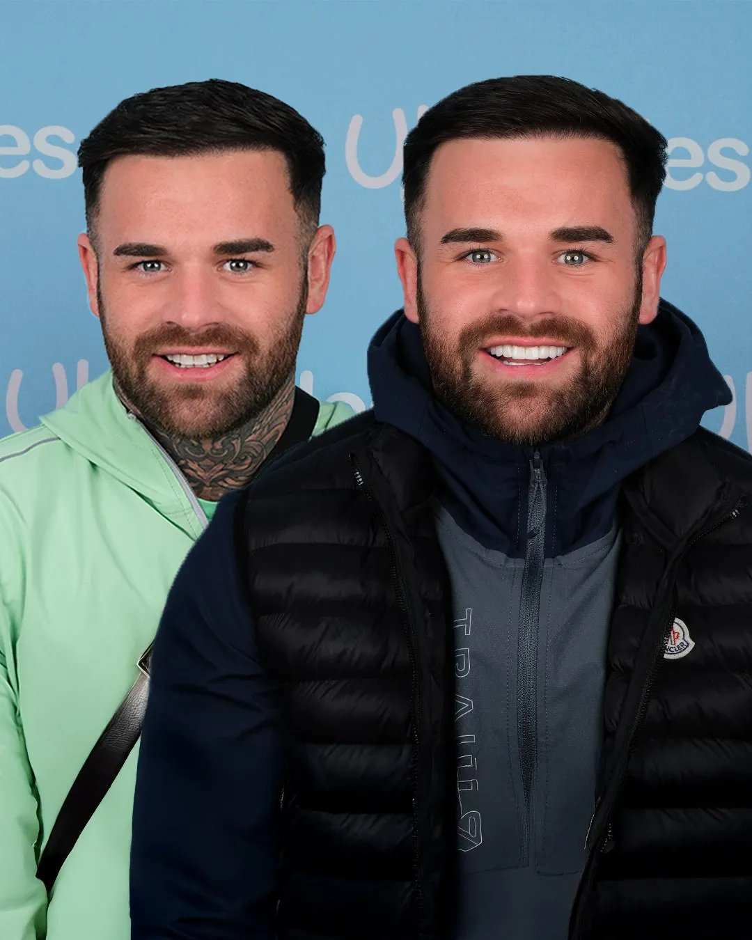 Man in a green hoodie before and after his new smile at UK Smiles