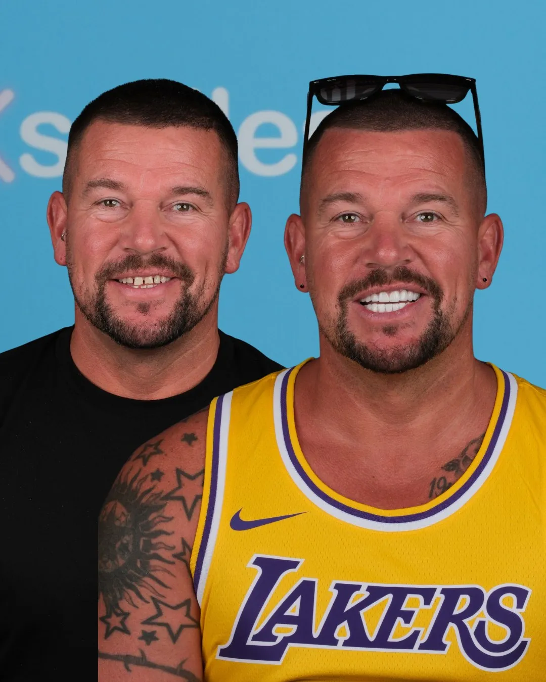Man in a Lakers vest before and after his smile makeover at UK Smiles