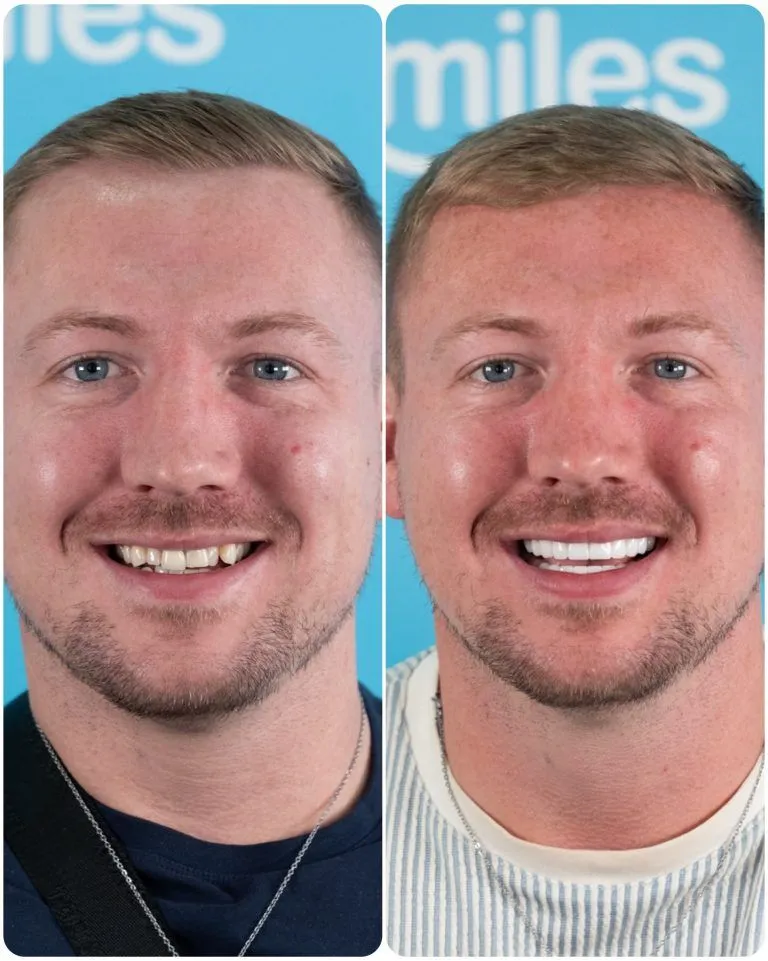 Man with a moustache before and after his smile makeover in Turkey