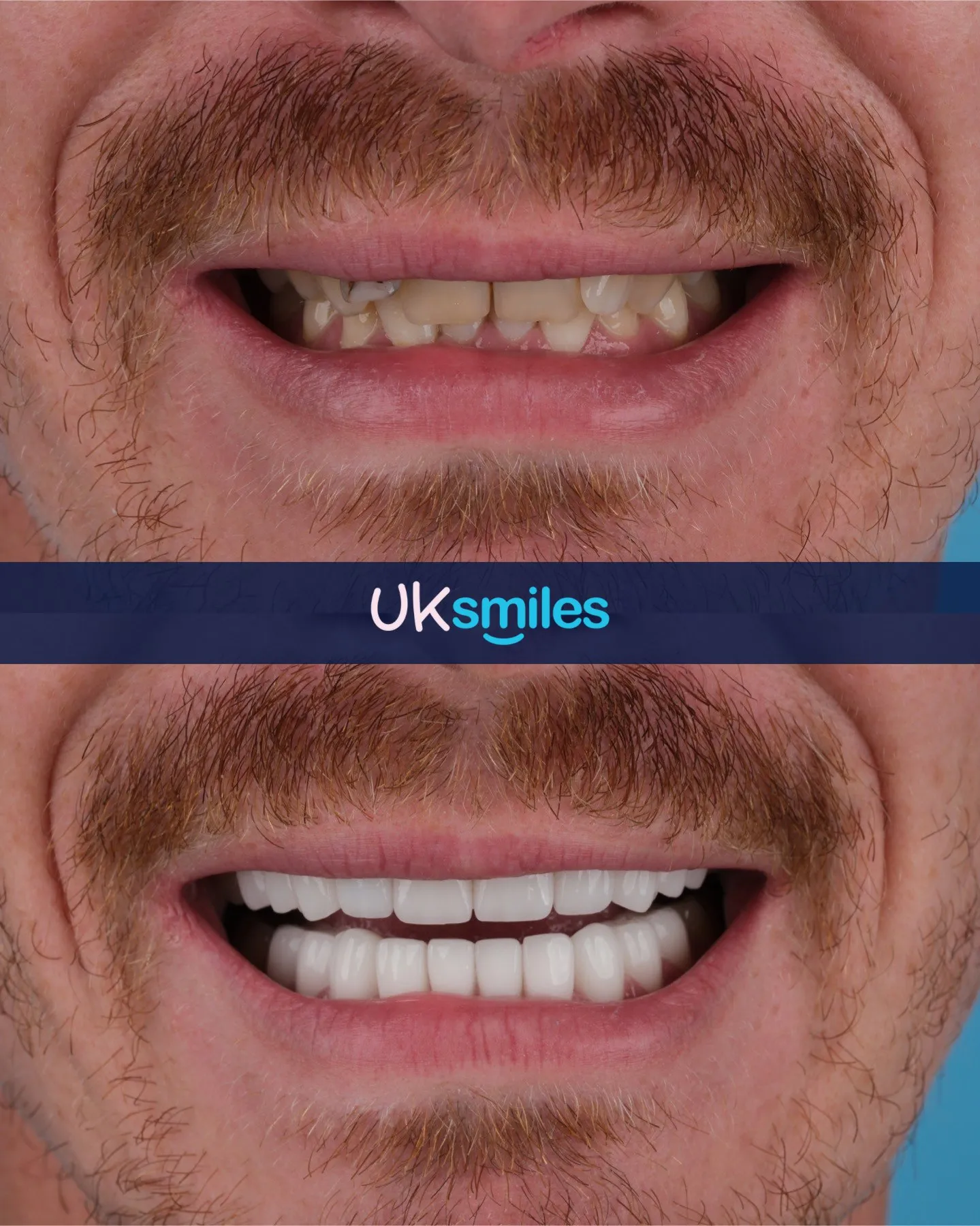 Close-up of a man's worn teeth before and bright new teeth after