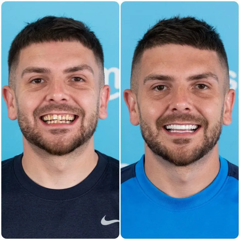 Man in a navy T-shirt with stained teeth before and a white smile after
