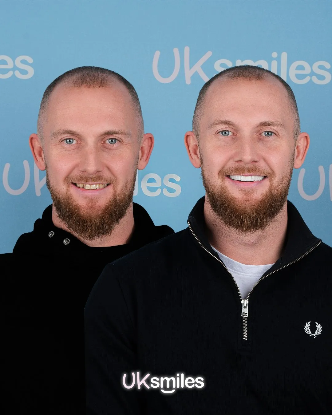 Man with a short beard before and after his new teeth