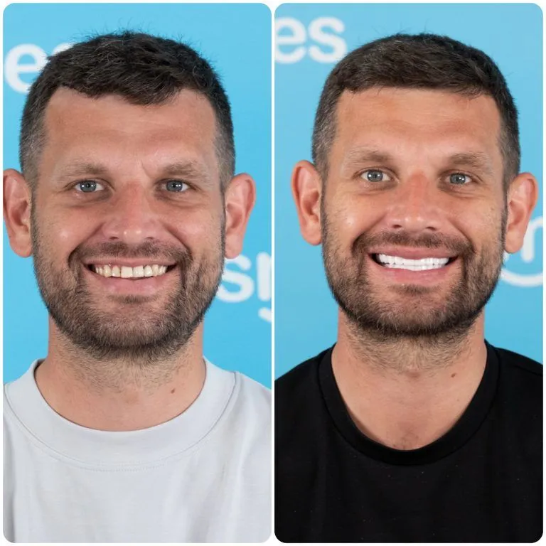 Man with short hair and a beard before and after his new teeth