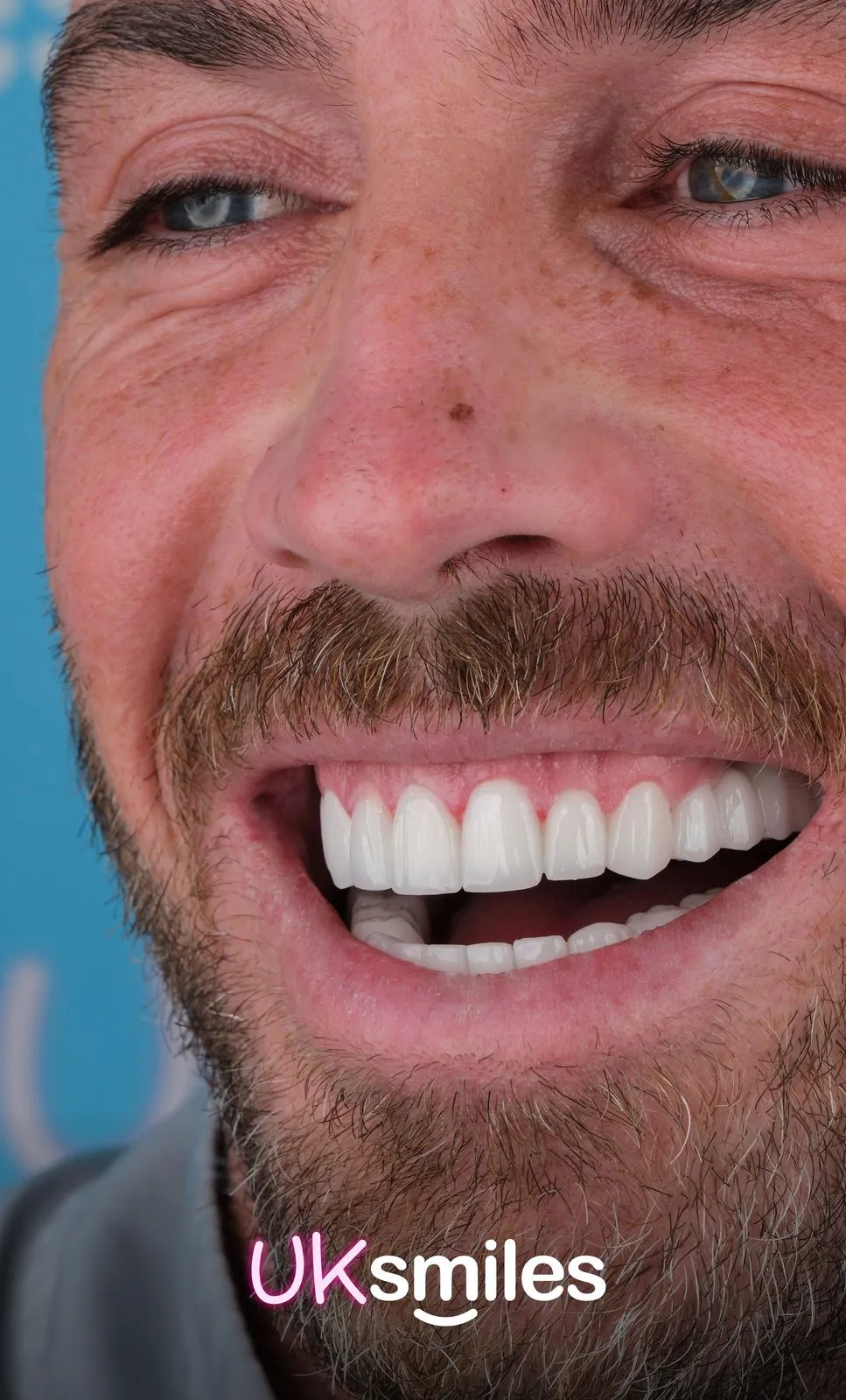 Close-up of a man with stubble showing his new white teeth