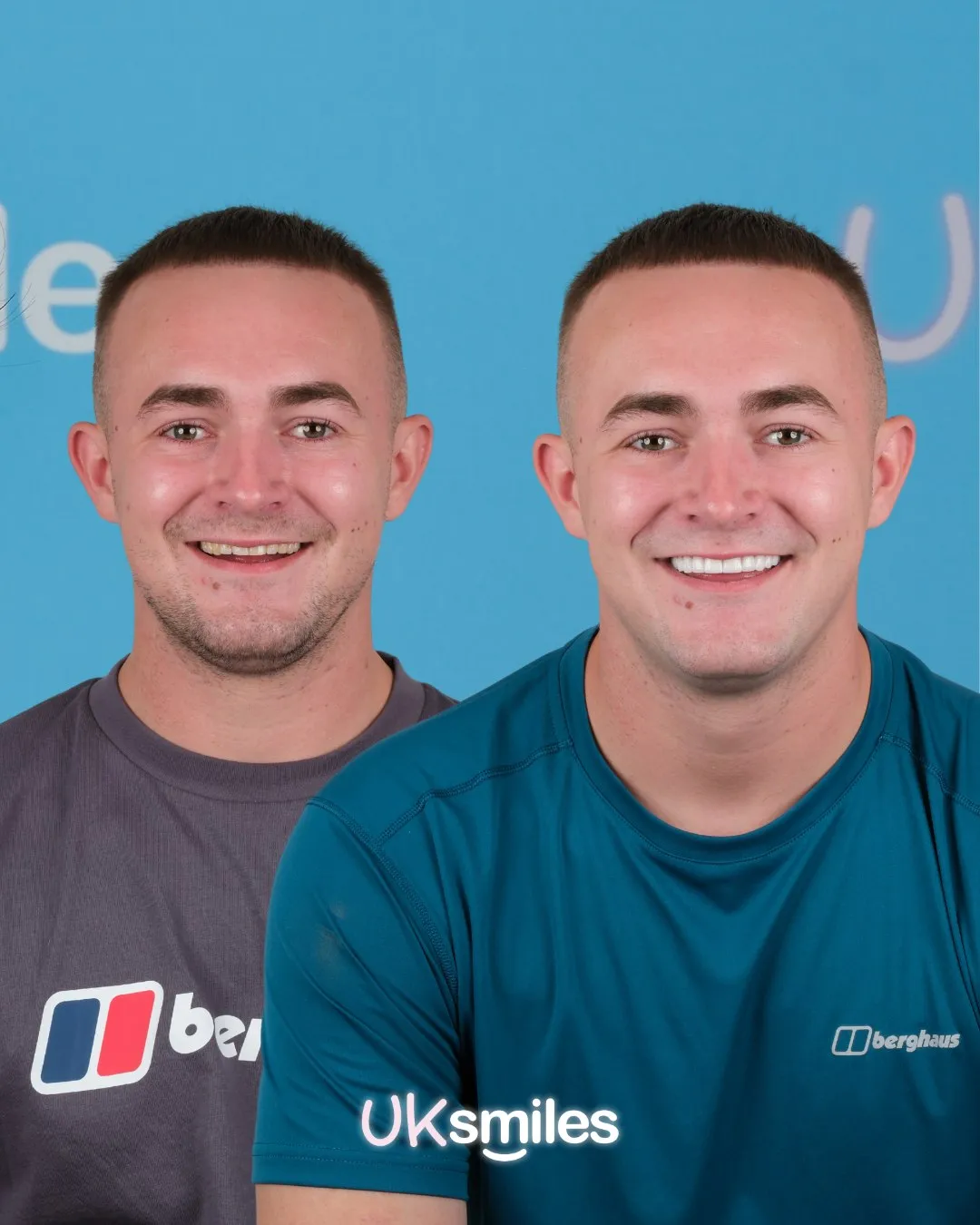 Man in a teal T-shirt before and after his new smile in Turkey