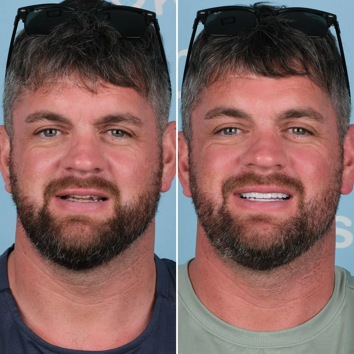 Mark before and after premium zirconia crowns with UK Smiles