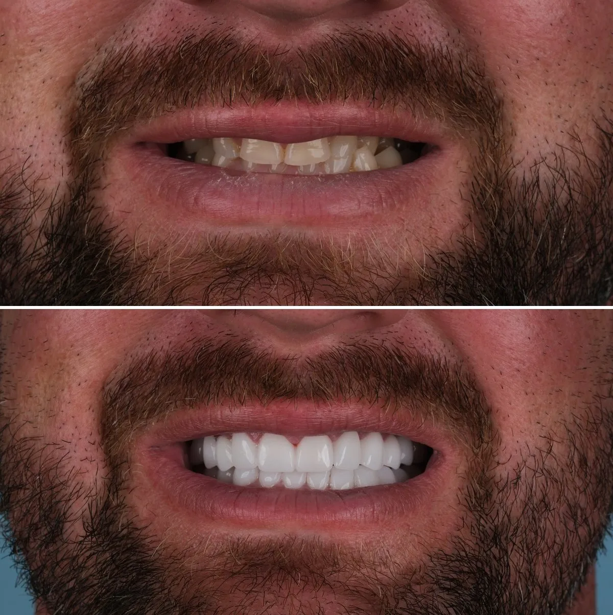 Close-up of Mark's teeth before and after Premium Zirconia Crowns, view 1