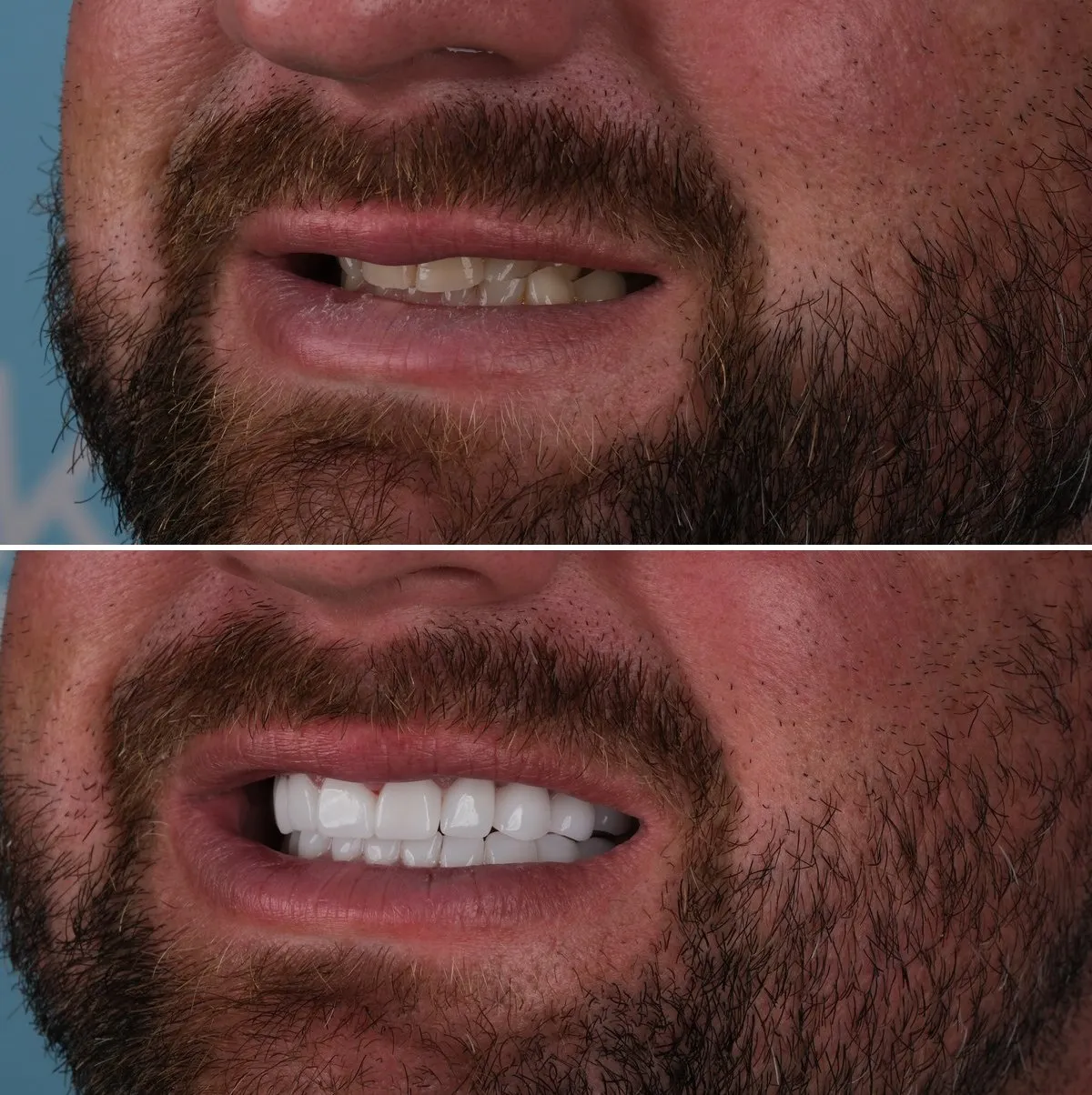 Close-up of Mark's teeth before and after Premium Zirconia Crowns, view 2