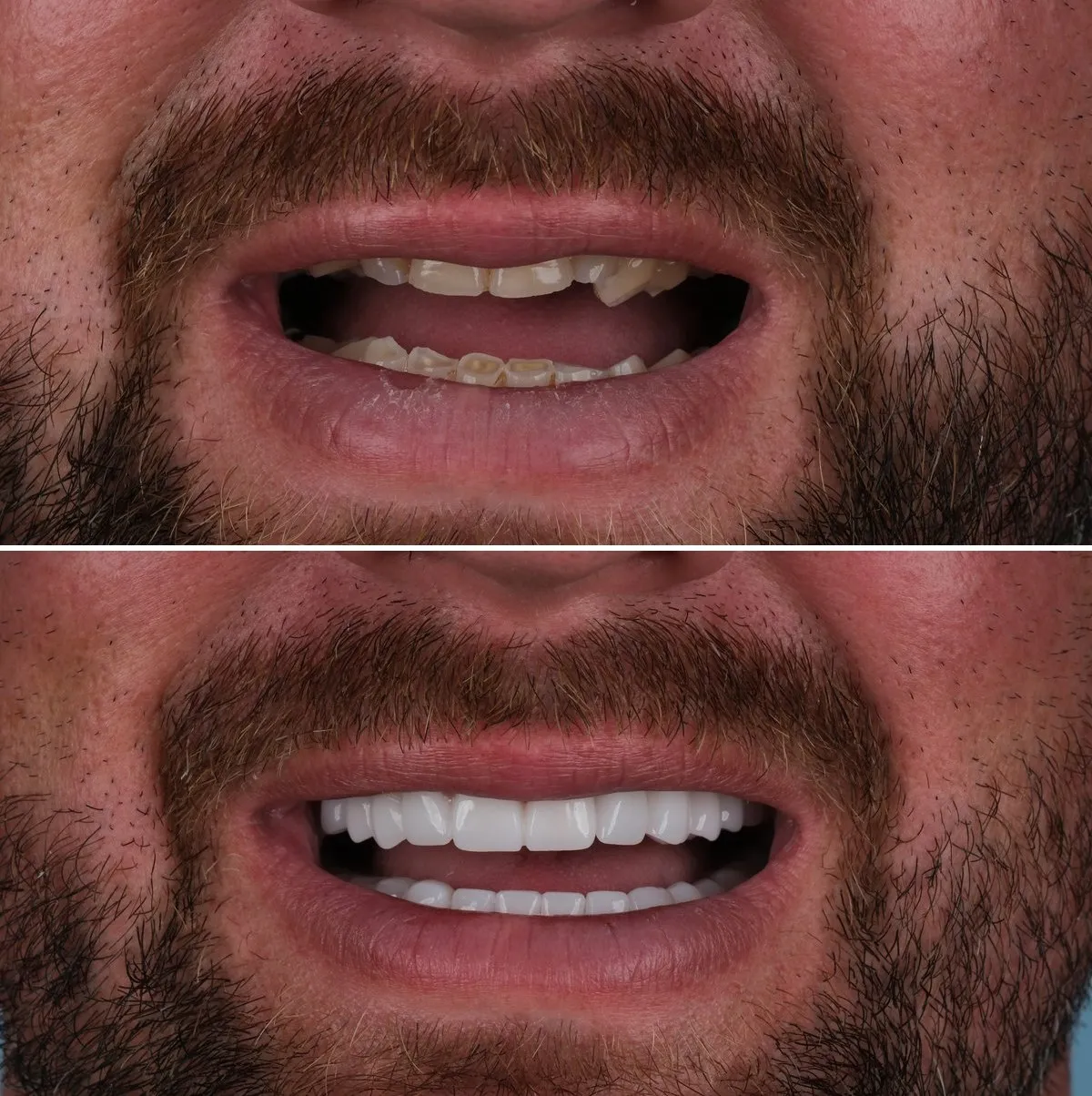 Close-up of Mark's teeth before and after Premium Zirconia Crowns, view 3