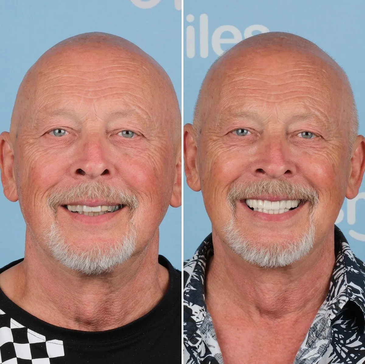 Michael before and after implants and crowns with UK Smiles
