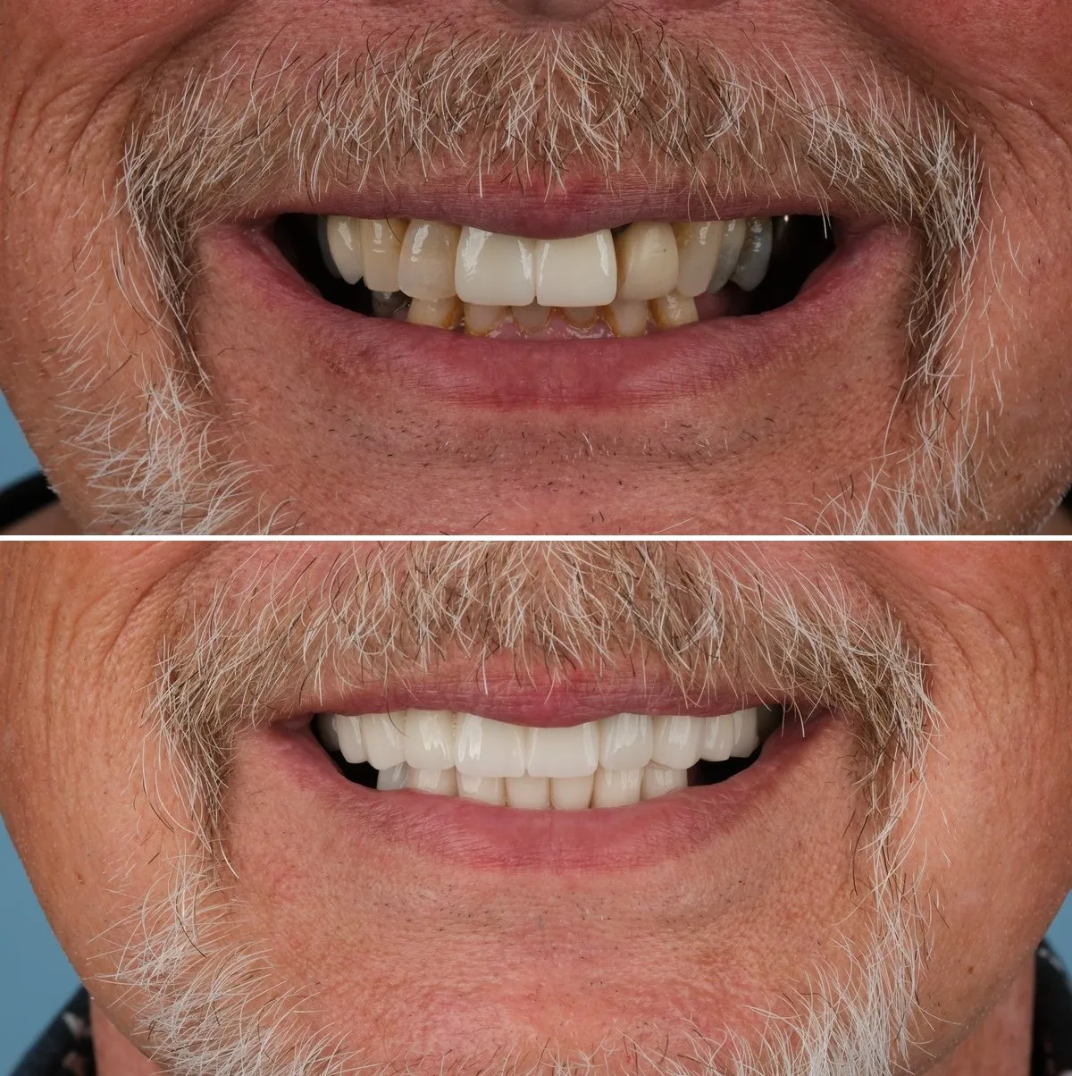 Close-up of Michael's teeth before and after Implants and Crowns, view 1