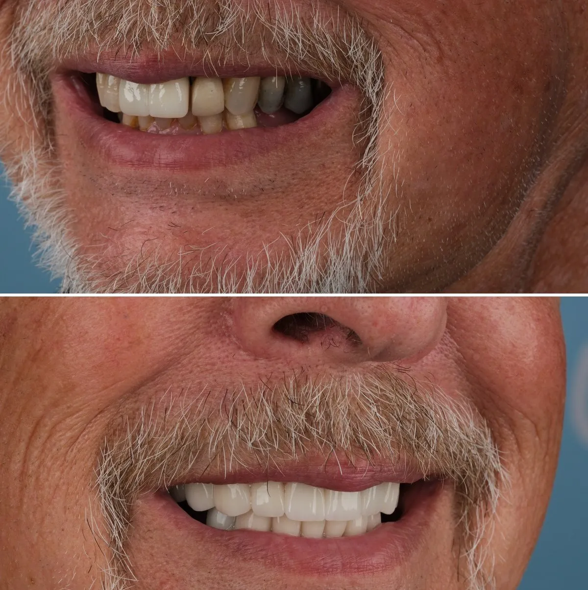 Close-up of Michael's teeth before and after Implants and Crowns, view 2