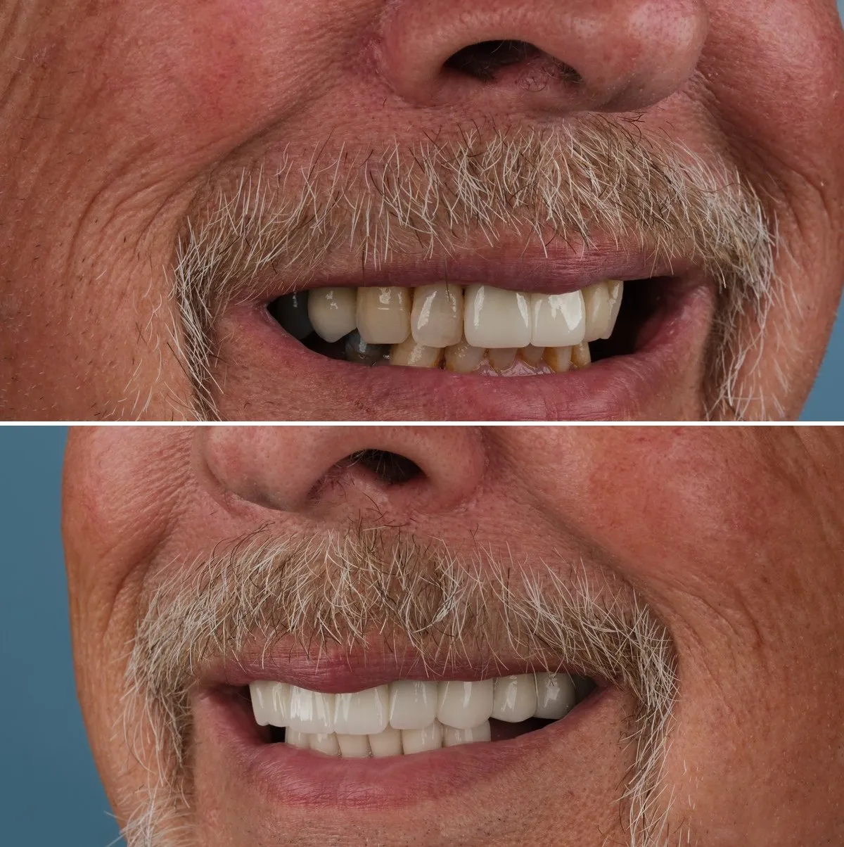 Close-up of Michael's teeth before and after Implants and Crowns, view 3
