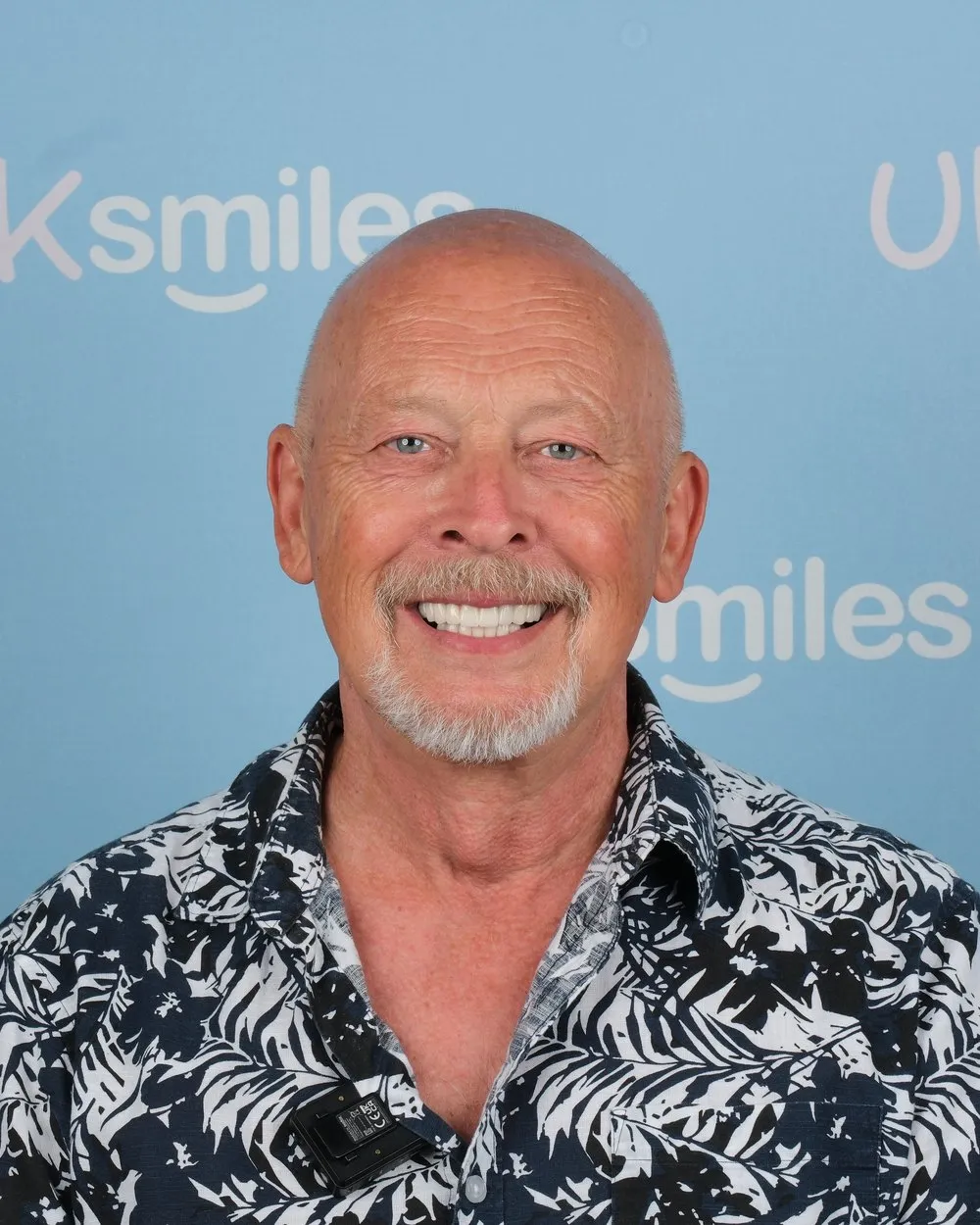 Michael after Implants and Crowns with UK Smiles in Antalya