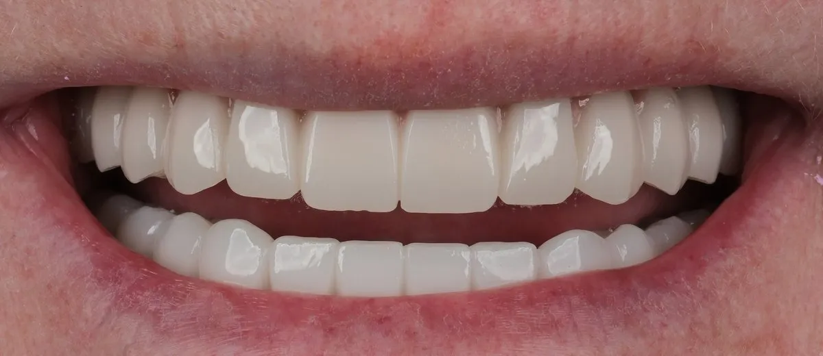 A UK Smiles patient's smile after treatment: BL3 shade, Softened style