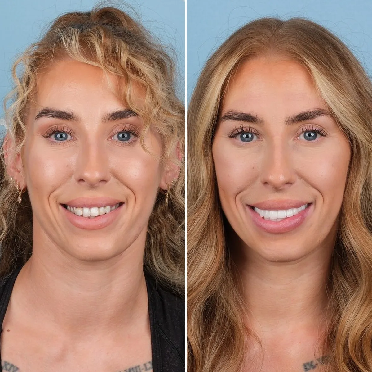 Naomi before and after zirconium crowns with UK Smiles