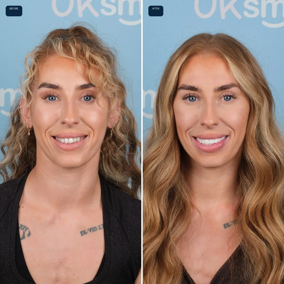 Naomi's face before and after Zirconium Crowns at UK Smiles in Antalya