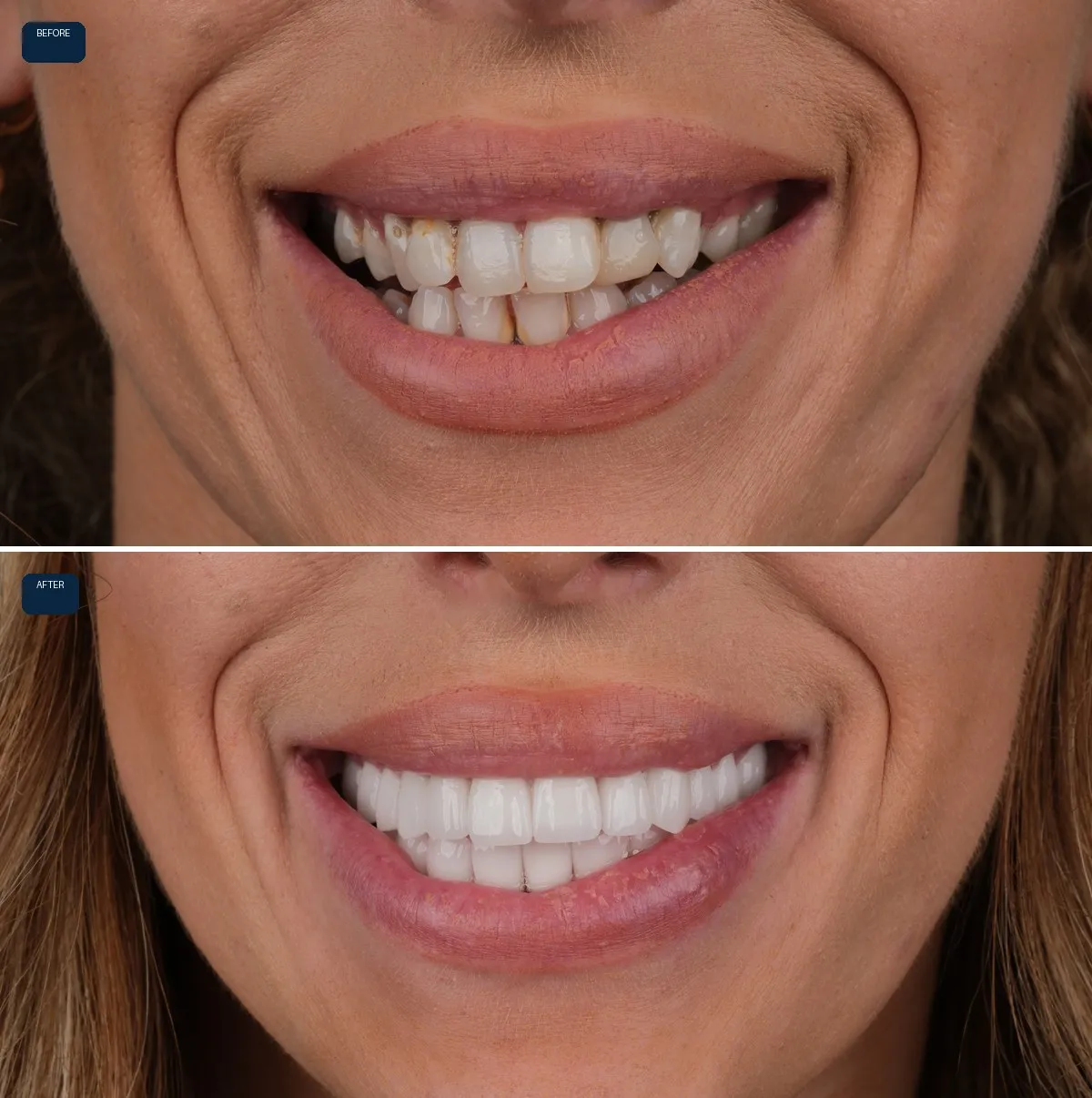 Close-up of Naomi's teeth before and after Zirconium Crowns, view 1