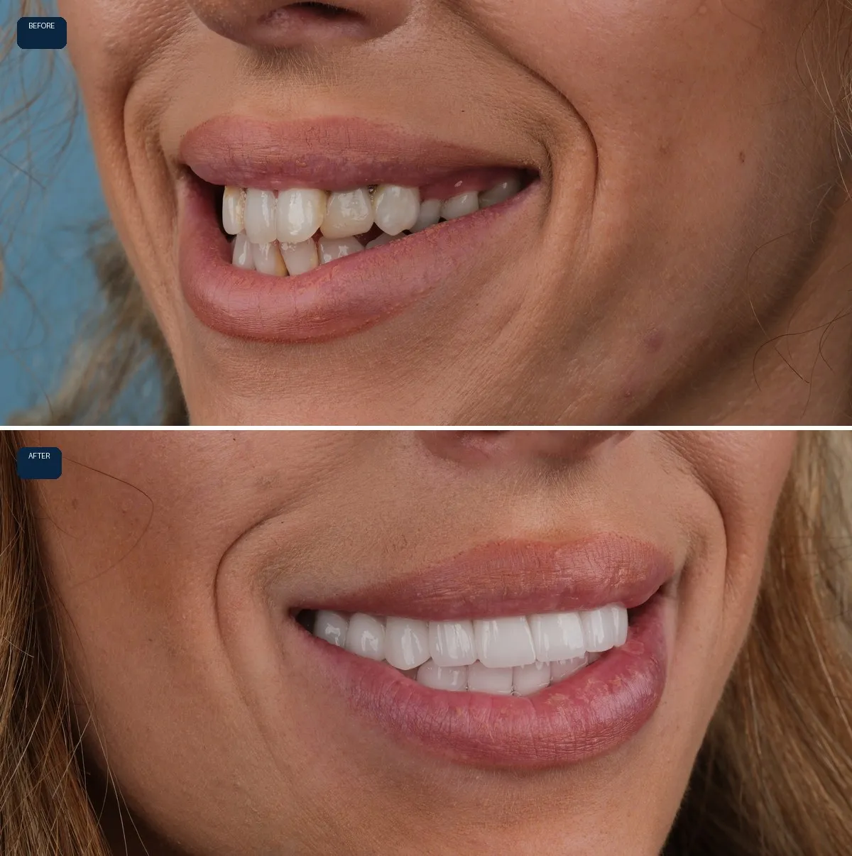 Close-up of Naomi's teeth before and after Zirconium Crowns, view 2
