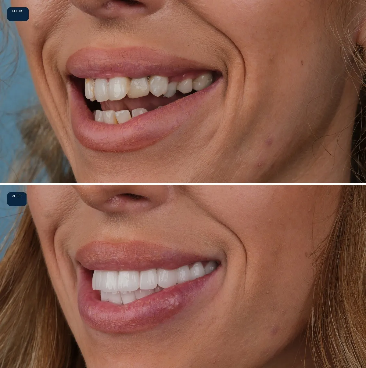 Close-up of Naomi's teeth before and after Zirconium Crowns, view 3