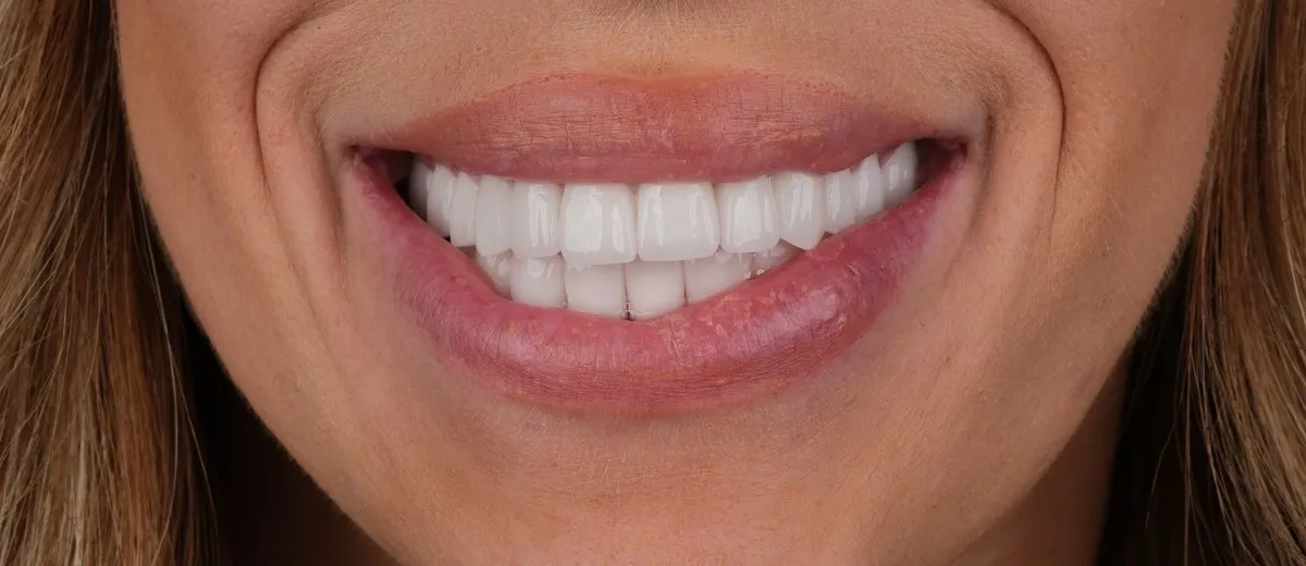 Naomi's smile after zirconia crowns in Turkey