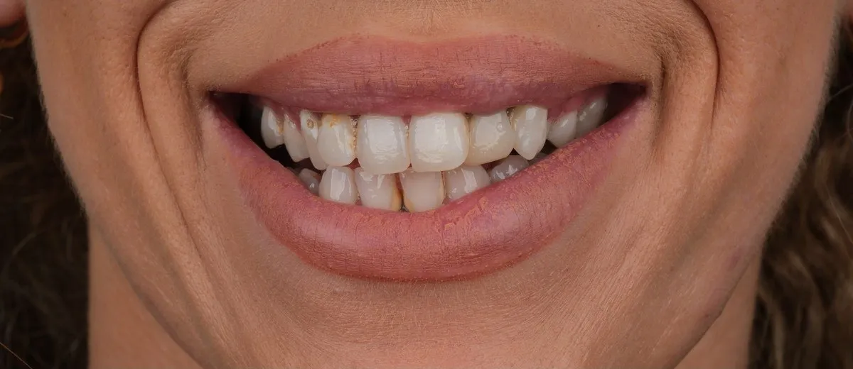 Naomi's teeth before crowns