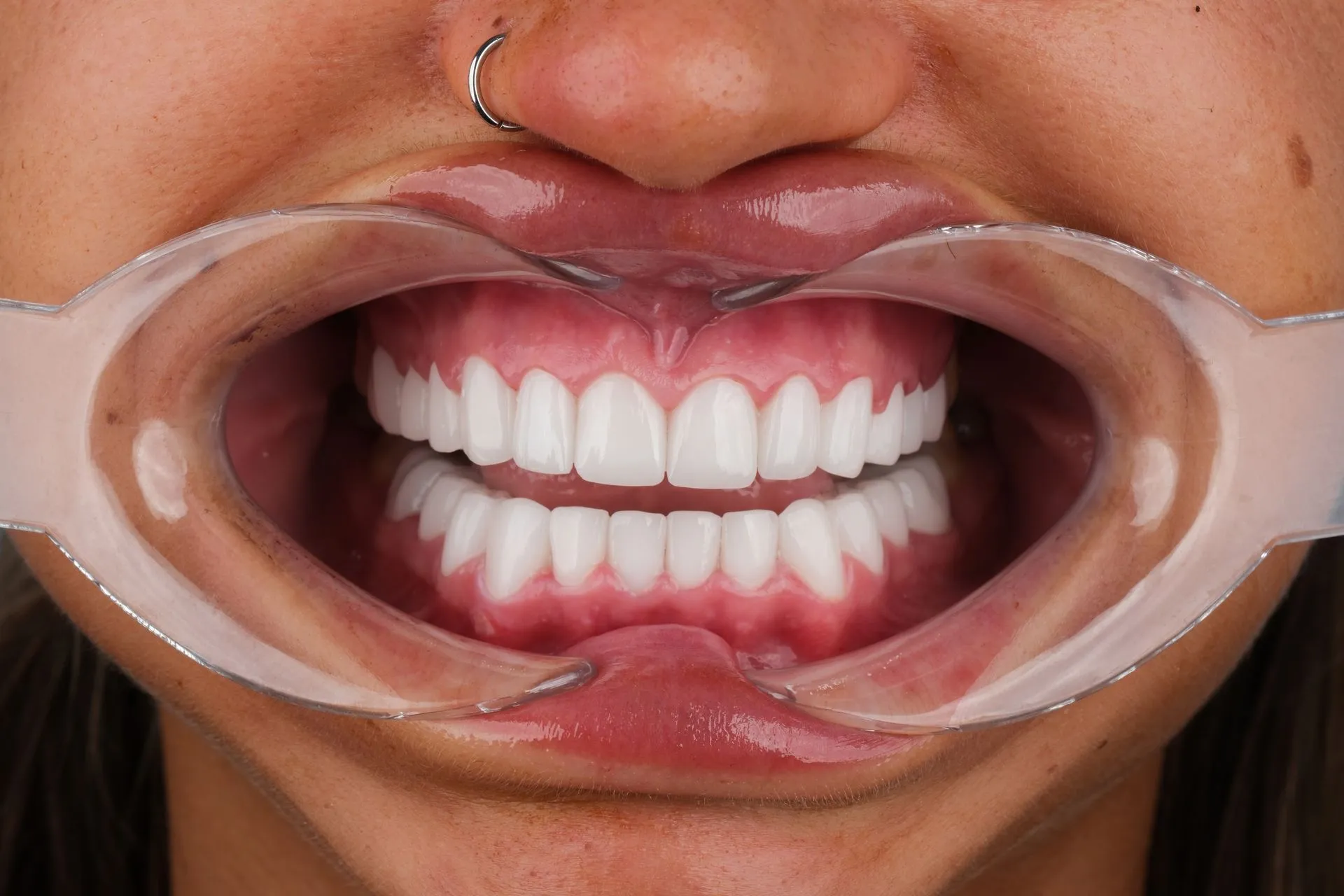Close-up of new white teeth with a lip retractor, checked at the clinic in Antalya