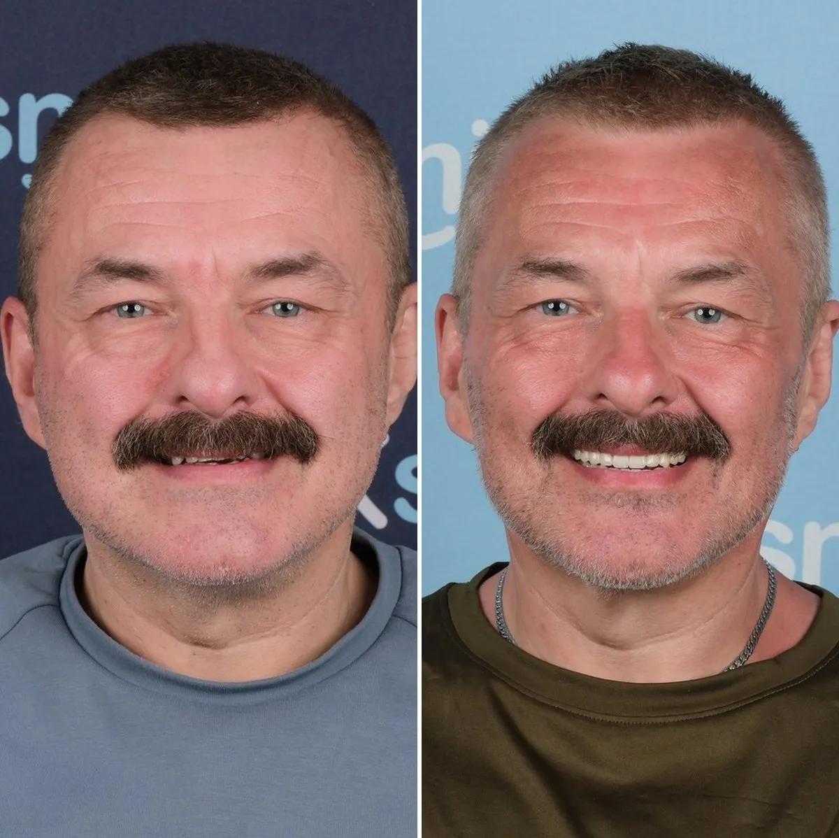 Nick before and after all-on-6 with UK Smiles