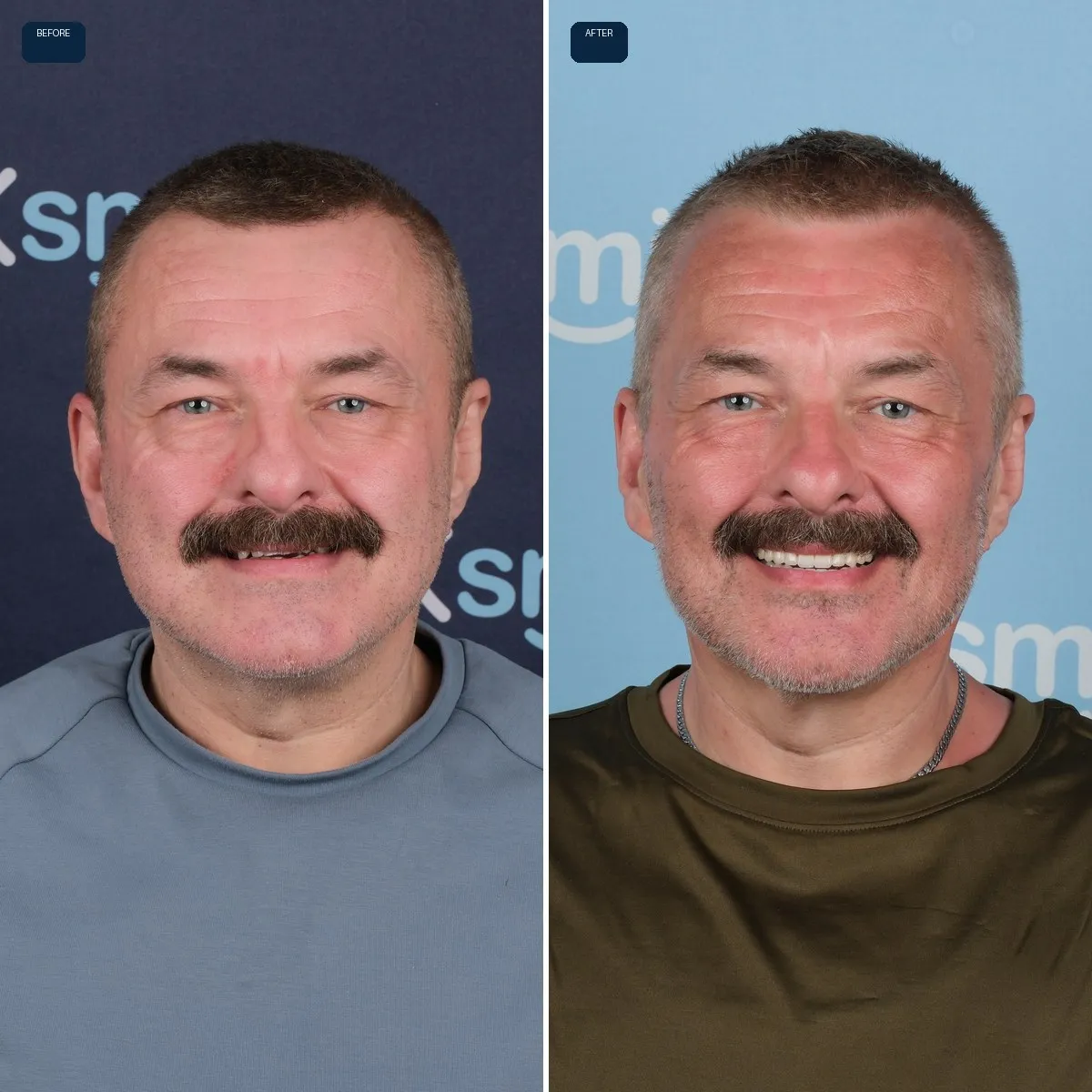 Nick's face before and after All-on-6 at UK Smiles in Antalya