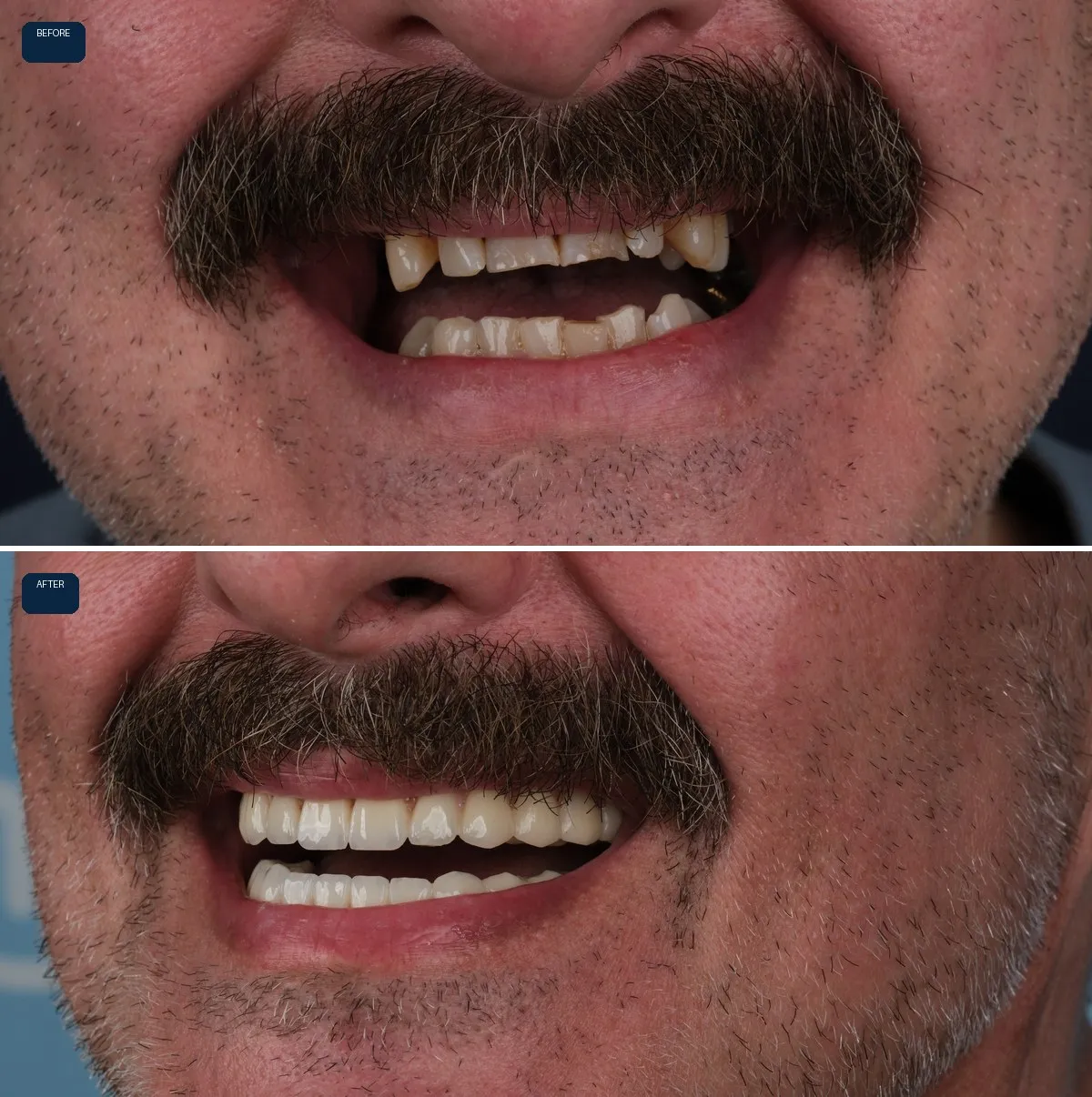 Close-up of Nick's teeth before and after All-on-6, view 1