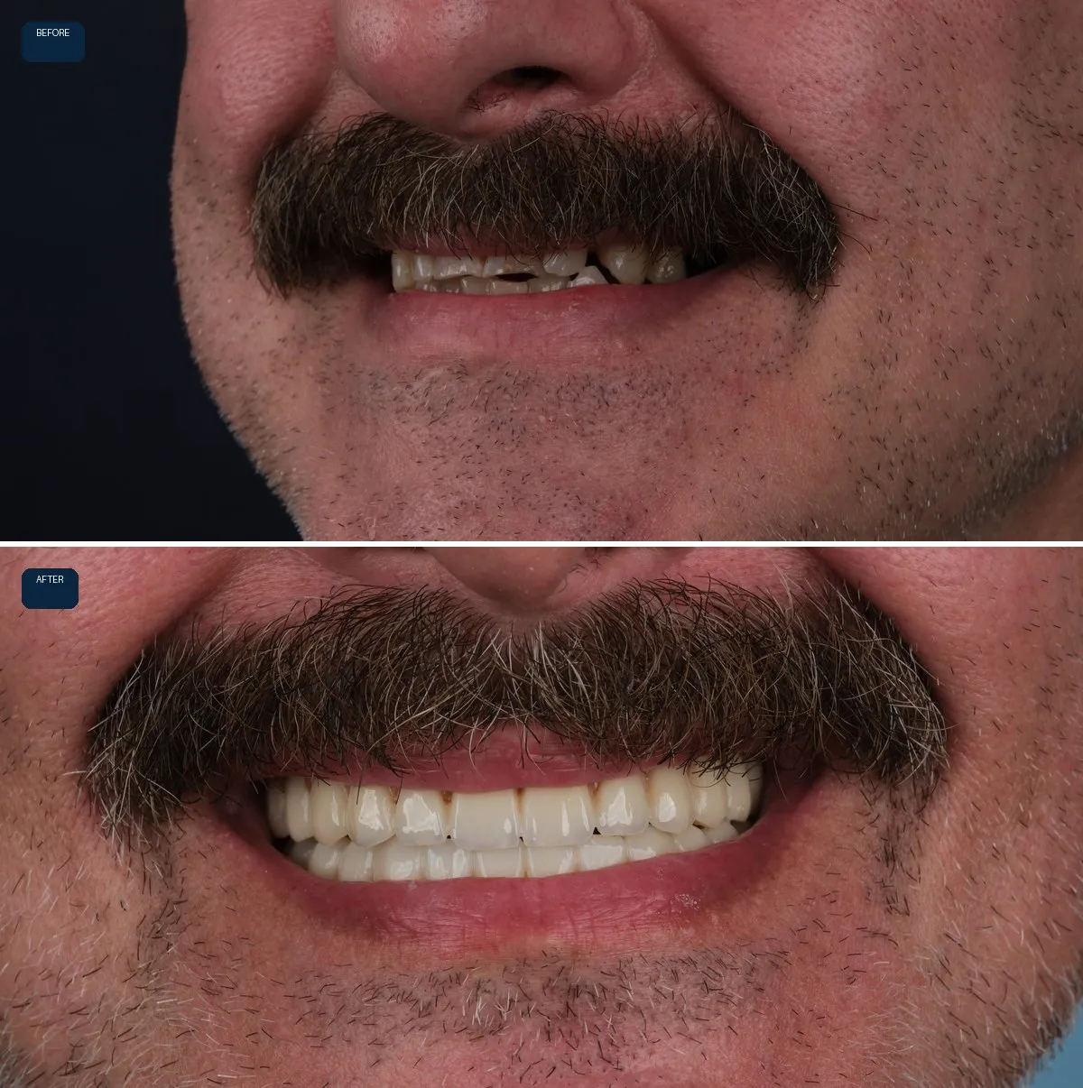 Close-up of Nick's teeth before and after All-on-6, view 2