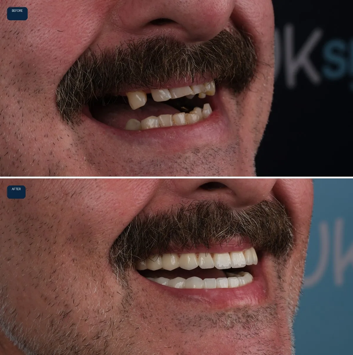 Close-up of Nick's teeth before and after All-on-6, view 3