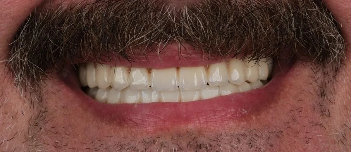 Nick after All-on-6, 12 implants and 24 zirconia crowns with UK Smiles