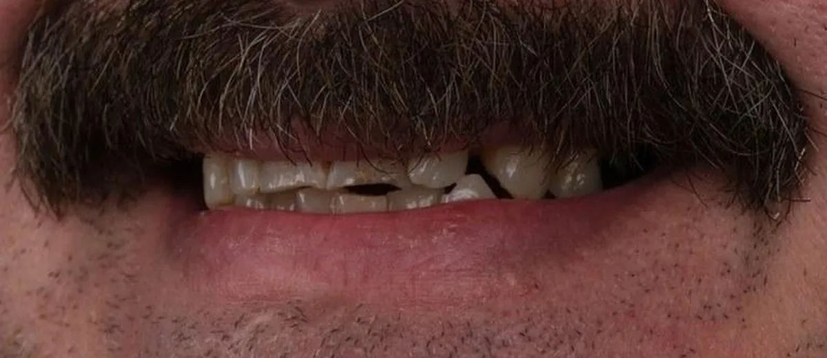 Nick before All-on-6, 12 implants and 24 zirconia crowns with UK Smiles