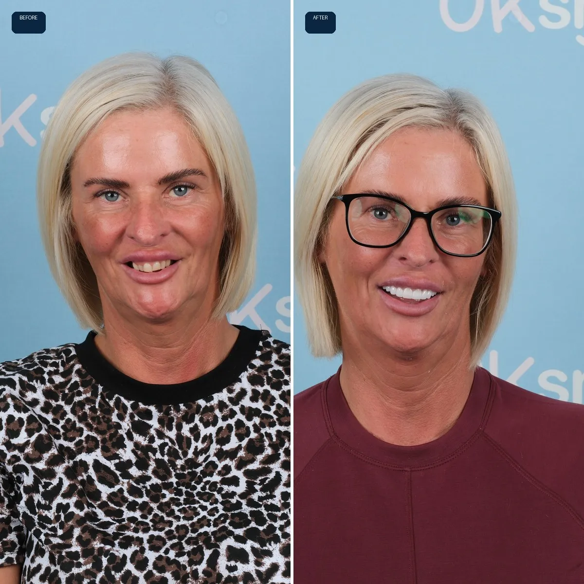 Nicola's face before and after Dental Implants and Zirconia Crowns at UK Smiles in Antalya