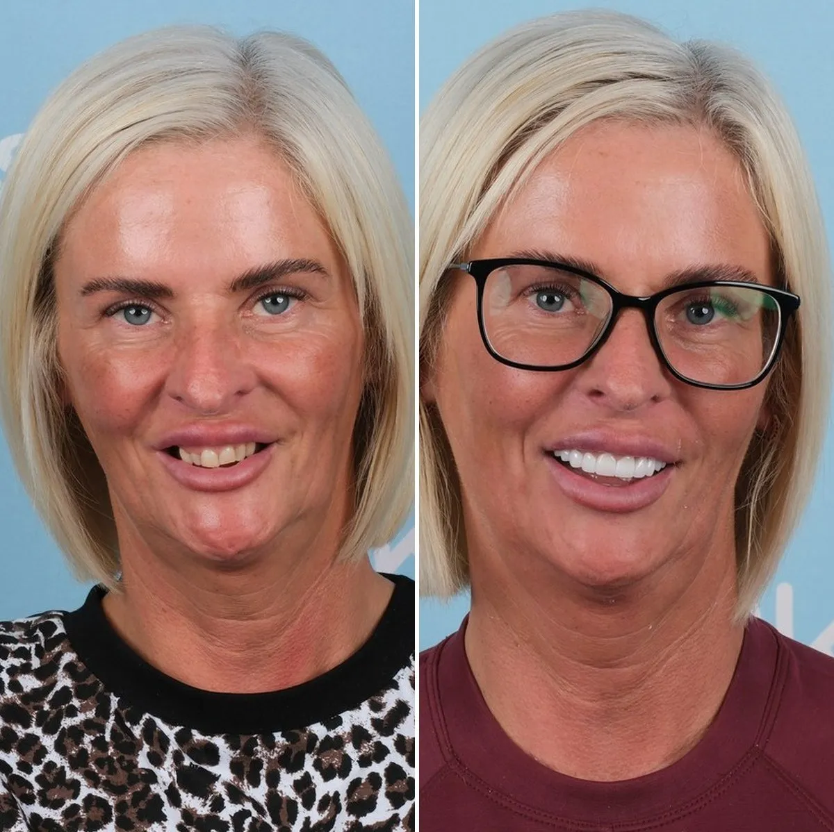 Nicola before and after implants and crowns with UK Smiles