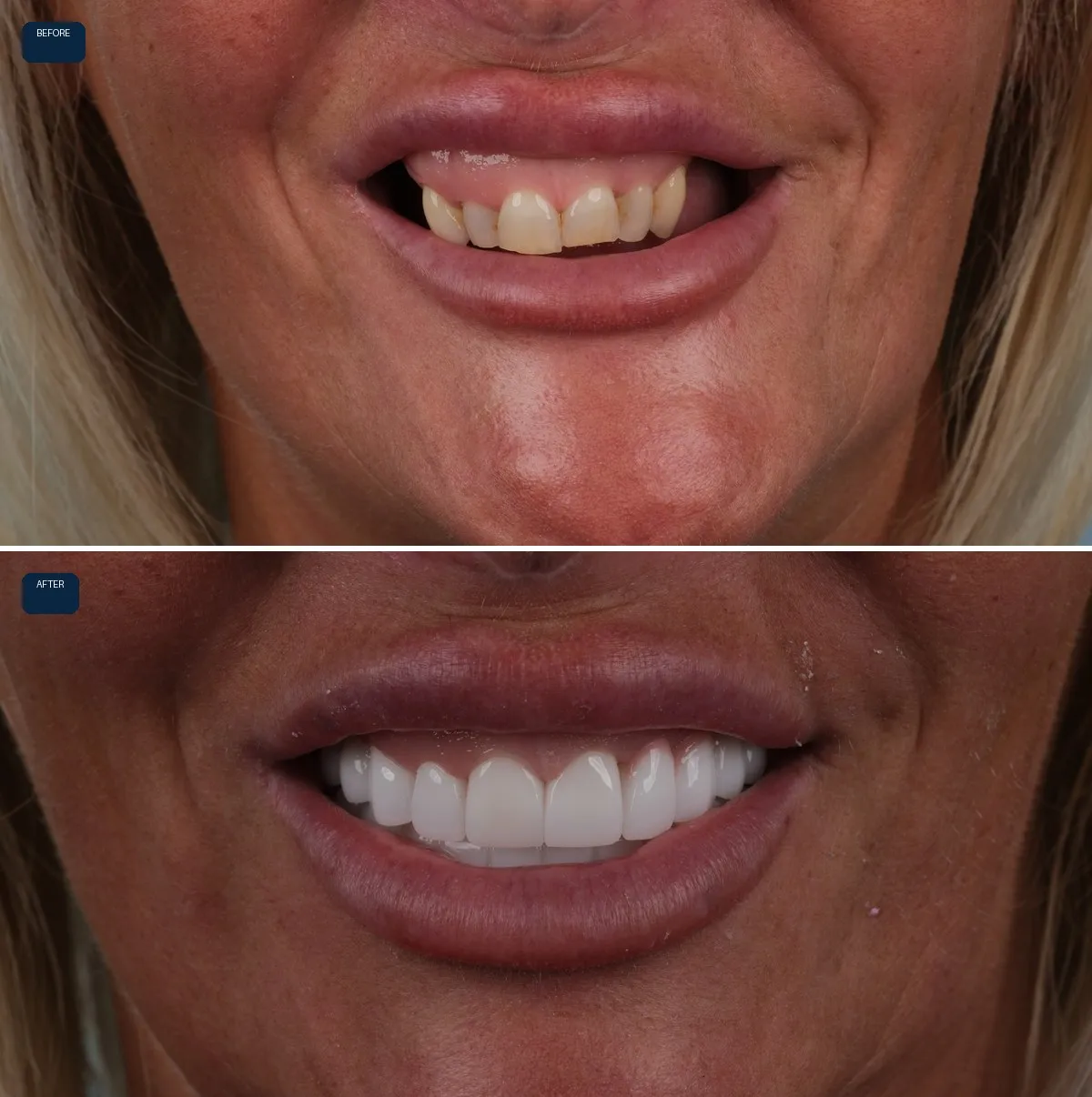 Close-up of Nicola's teeth before and after Dental Implants and Zirconia Crowns, view 1